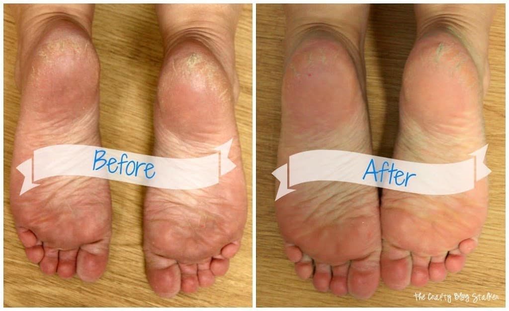 A pair of feet before and after the Listerine foot soak.